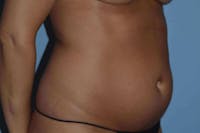 Liposuction Before & After Gallery - Patient 14281448 - Image 1