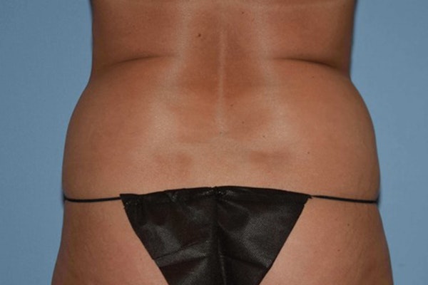 Liposuction Before & After Gallery - Patient 14281448 - Image 5