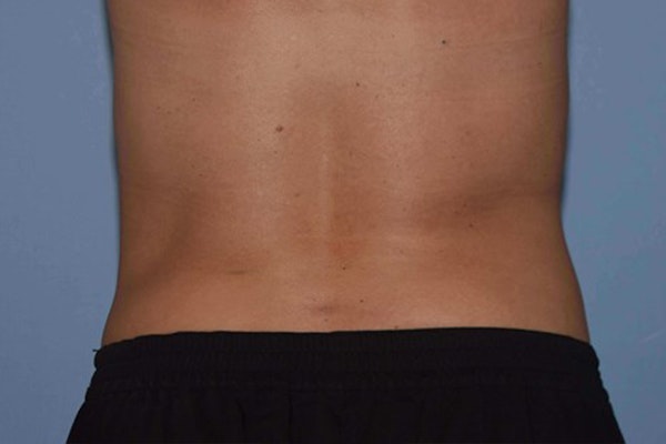Liposuction Before & After Gallery - Patient 14281448 - Image 6