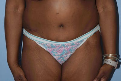 Liposuction Before & After Gallery - Patient 14281453 - Image 2