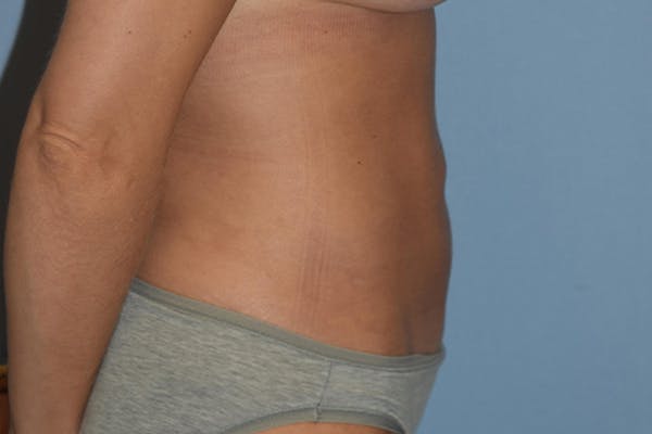 Liposuction Before & After Gallery - Patient 15930154 - Image 6