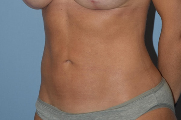Liposuction Before & After Gallery - Patient 15930154 - Image 10