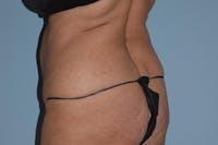 Liposuction Before & After Gallery - Patient 16555407 - Image 1