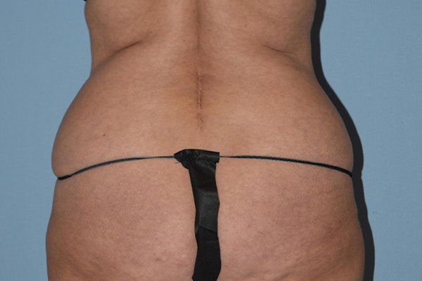 Liposuction Before & After Gallery - Patient 16555407 - Image 3