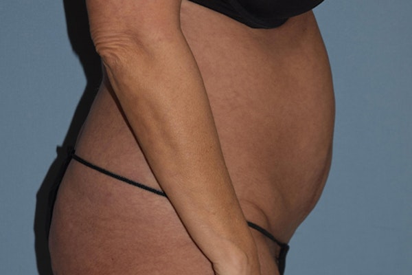 Liposuction Before & After Gallery - Patient 16555407 - Image 7