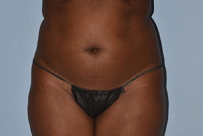 Liposuction Before & After Gallery - Patient 16555408 - Image 1