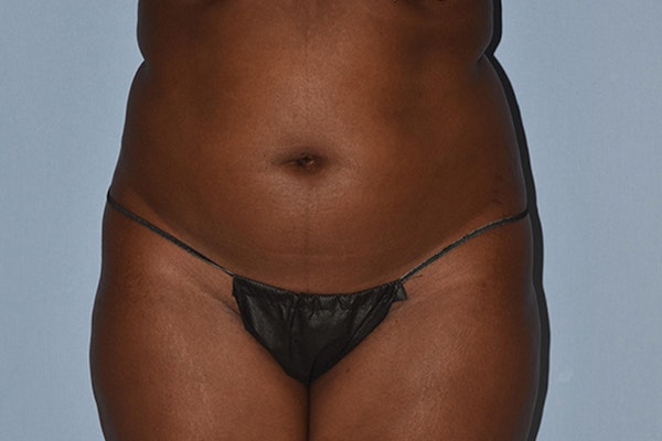 Liposuction Before & After Gallery - Patient 16555408 - Image 1