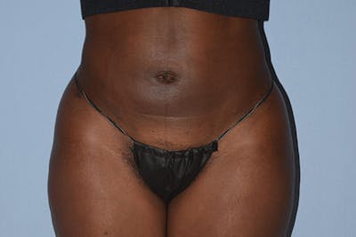 Liposuction Gallery - Patient 16555408 - Image 2