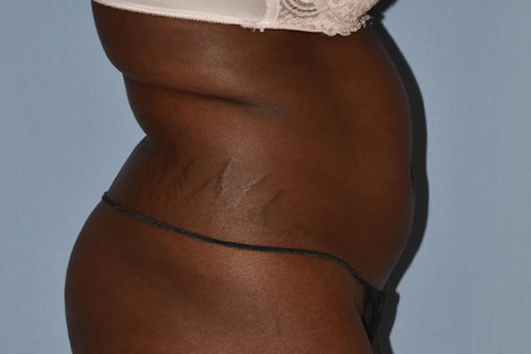 Liposuction Gallery - Patient 16555408 - Image 5