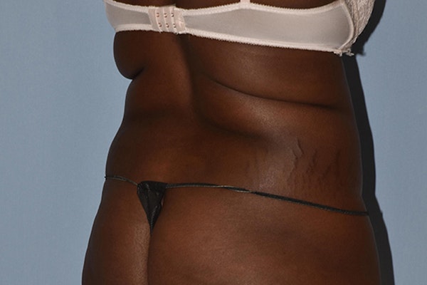 Liposuction Before & After Gallery - Patient 16555408 - Image 7