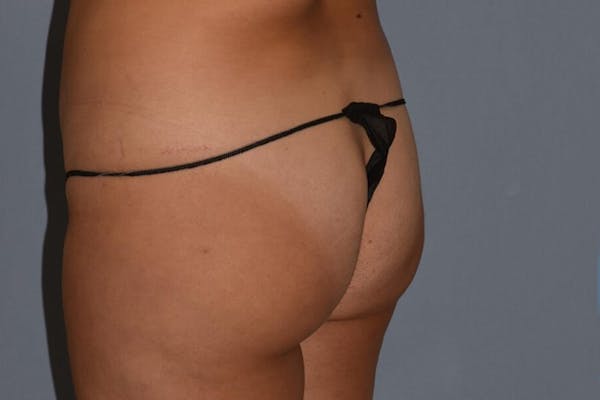 Brazilian Butt Lift Gallery - Patient 14281484 - Image 3