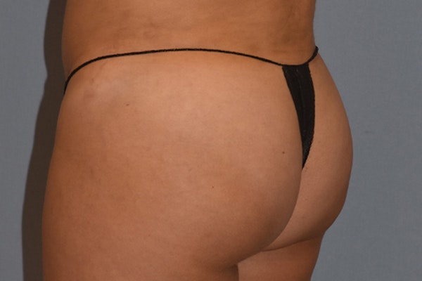 Brazilian Butt Lift Before & After Gallery - Patient 16508712 - Image 6