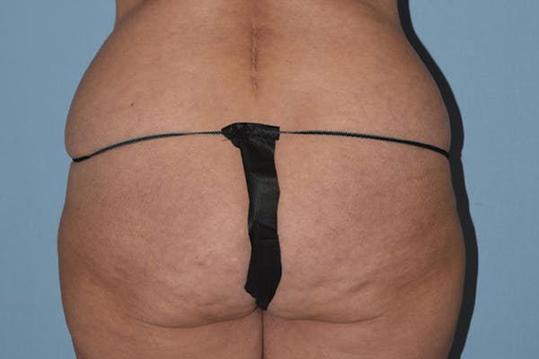 Brazilian Butt Lift Before & After Gallery - Patient 16560625 - Image 1