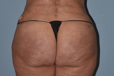 Brazilian Butt Lift Gallery - Patient 16560625 - Image 2