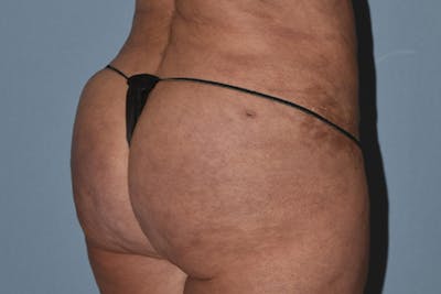 Brazilian Butt Lift Before & After Gallery - Patient 16560625 - Image 4