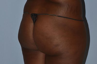 Brazilian Butt Lift Before & After Gallery - Patient 16560626 - Image 1