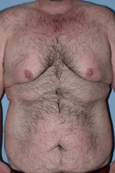 After Weight Loss Surgery Before & After Gallery - Patient 14281499 - Image 1