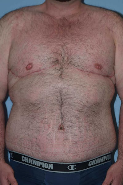 After Weight Loss Surgery Before & After Gallery - Patient 14281499 - Image 2