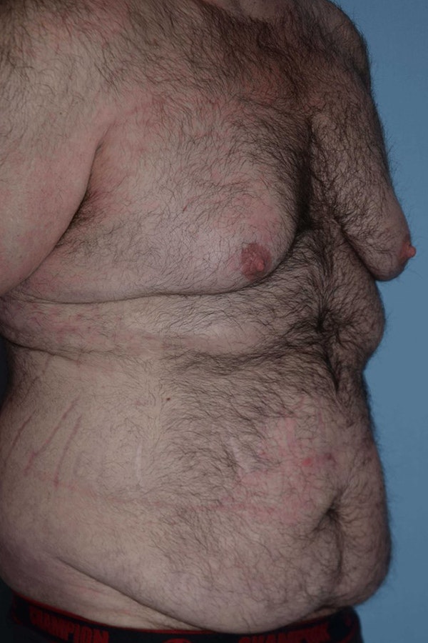 After Weight Loss Surgery Before & After Gallery - Patient 14281499 - Image 3