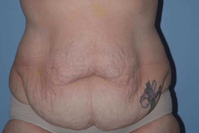 After Weight Loss Surgery Before & After Gallery - Patient 14281501 - Image 1