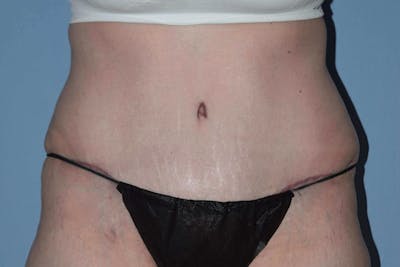 After Weight Loss Surgery Before & After Gallery - Patient 14281501 - Image 2