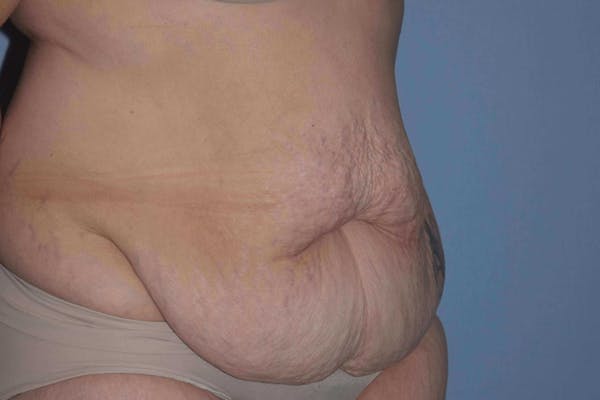 After Weight Loss Surgery Gallery - Patient 14281501 - Image 3