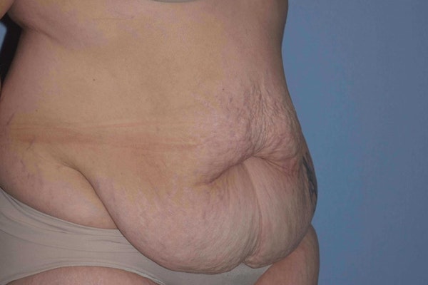 After Weight Loss Surgery Before & After Gallery - Patient 14281501 - Image 3