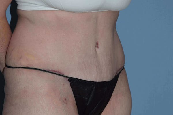 After Weight Loss Surgery Gallery - Patient 14281501 - Image 4