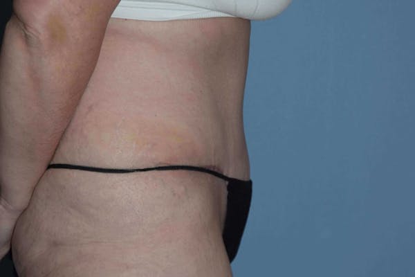 After Weight Loss Surgery Gallery - Patient 14281501 - Image 6