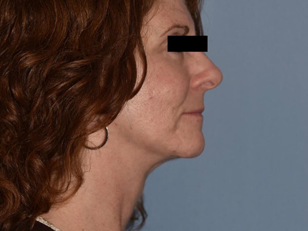 Facelift Before & After Gallery - Patient 14281770 - Image 6
