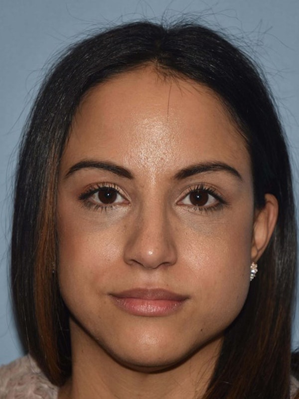 Rhinoplasty Before & After Gallery - Patient 14281860 - Image 6
