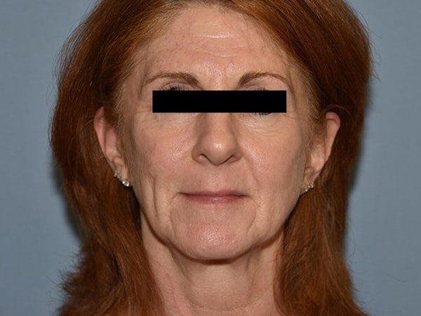 Facial Fat Grafting Before & After Gallery - Patient 6389439 - Image 1