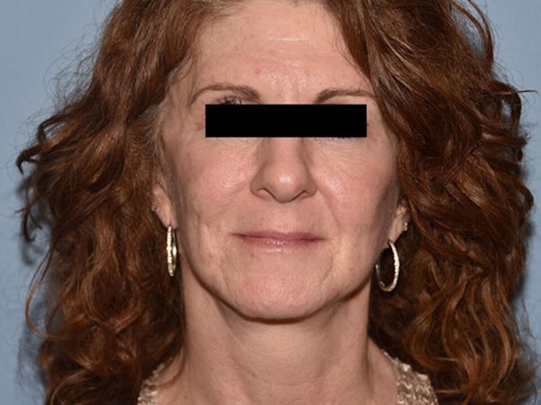 Facial Fat Grafting Before & After Gallery - Patient 6389439 - Image 2
