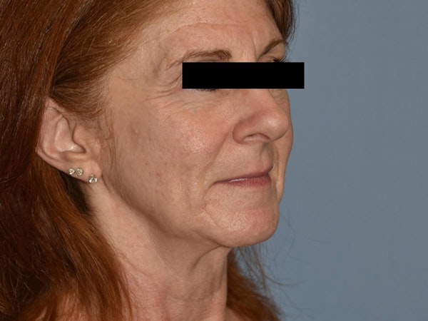 Facial Fat Grafting Before & After Gallery - Patient 6389439 - Image 3