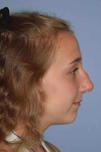 Nonsurgical Rhinoplasty Before & After Gallery - Patient 6389441 - Image 1