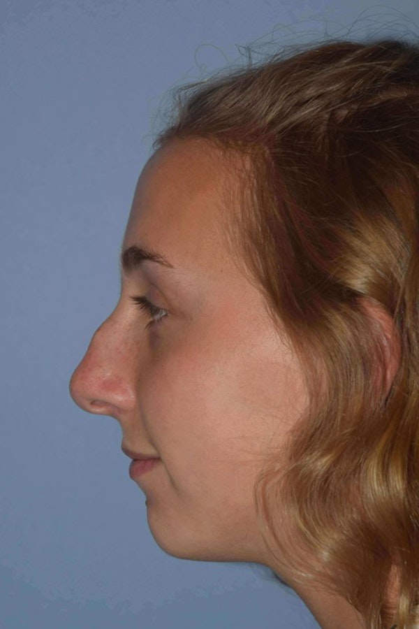 Nonsurgical Rhinoplasty Before & After Gallery - Patient 6389441 - Image 3