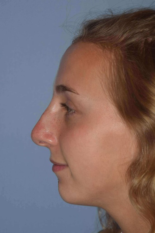 Nonsurgical Rhinoplasty Before & After Gallery - Patient 6389441 - Image 4