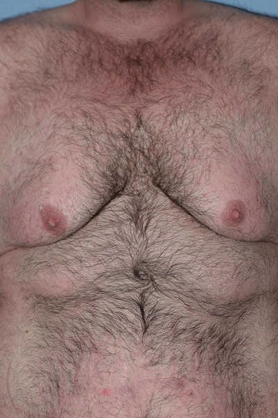 Gynecomastia Before & After Gallery - Patient 14281887 - Image 1