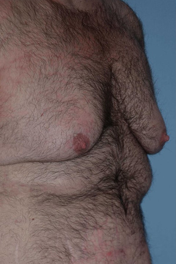 Gynecomastia Before & After Gallery - Patient 14281887 - Image 3
