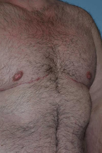 Gynecomastia Before & After Gallery - Patient 14281887 - Image 4