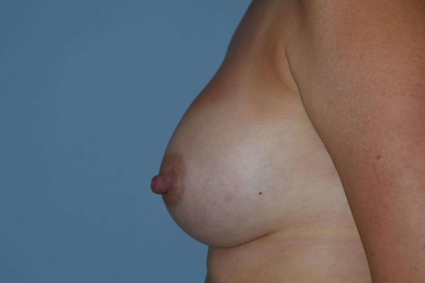 Breast Augmentation Before & After Gallery - Patient 14281575 - Image 6