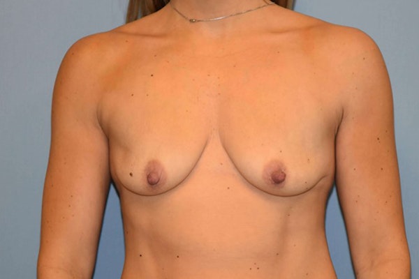 Breast Augmentation Before & After Gallery - Patient 14281589 - Image 1