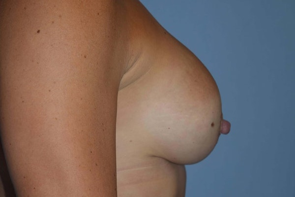 Breast Augmentation Before & After Gallery - Patient 14281589 - Image 8