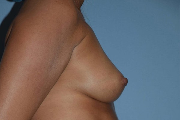 Breast Augmentation Before & After Gallery - Patient 14281590 - Image 3
