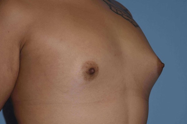 Breast Augmentation Before & After Gallery - Patient 14281591 - Image 3