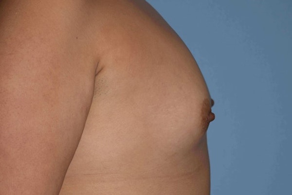 Breast Augmentation Before & After Gallery - Patient 14281591 - Image 5