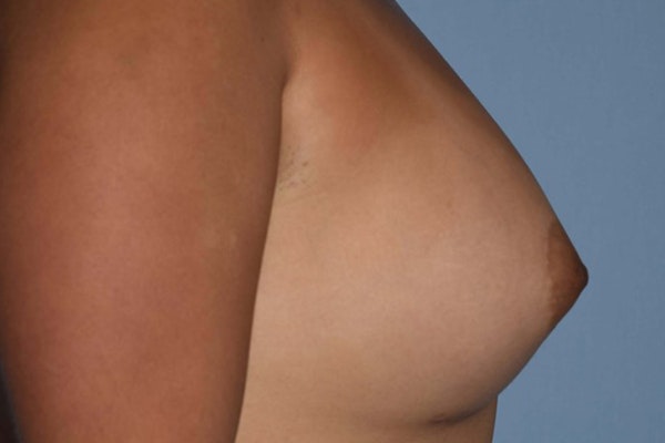 Breast Augmentation Before & After Gallery - Patient 14281591 - Image 6
