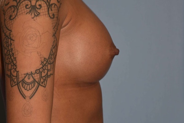 Breast Augmentation Before & After Gallery - Patient 14281597 - Image 6