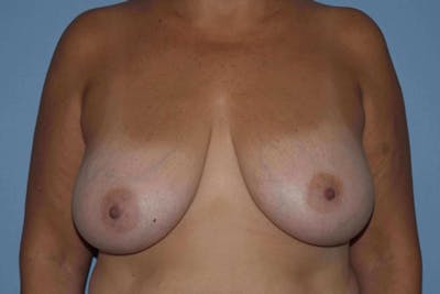 Breast Reduction Before & After Gallery - Patient 14281628 - Image 1