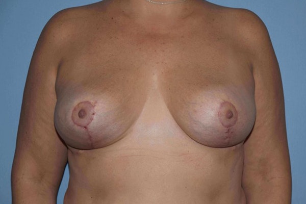 Breast Reduction Before & After Gallery - Patient 14281628 - Image 2